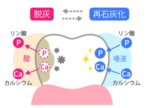 埼玉県川口市新井宿の歯科医院、アール歯科クリニック新井宿では歯面にフッ素を塗布することで再石灰化を促すなど、効果の高いむし歯予防を行っています。